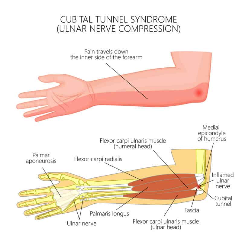 Physical Therapist's Guide to Cubital Tunnel Syndrome