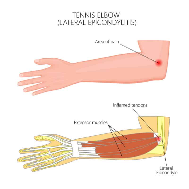 Elbow Conditions Elbow Injuries FORM Hand Wrist Elbow Institute